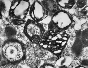 M,58y. | crystalline inclusions in hepatocyte after unknown medication M,58y. | crystalline inclusions in hepatocyte after unknown medication
